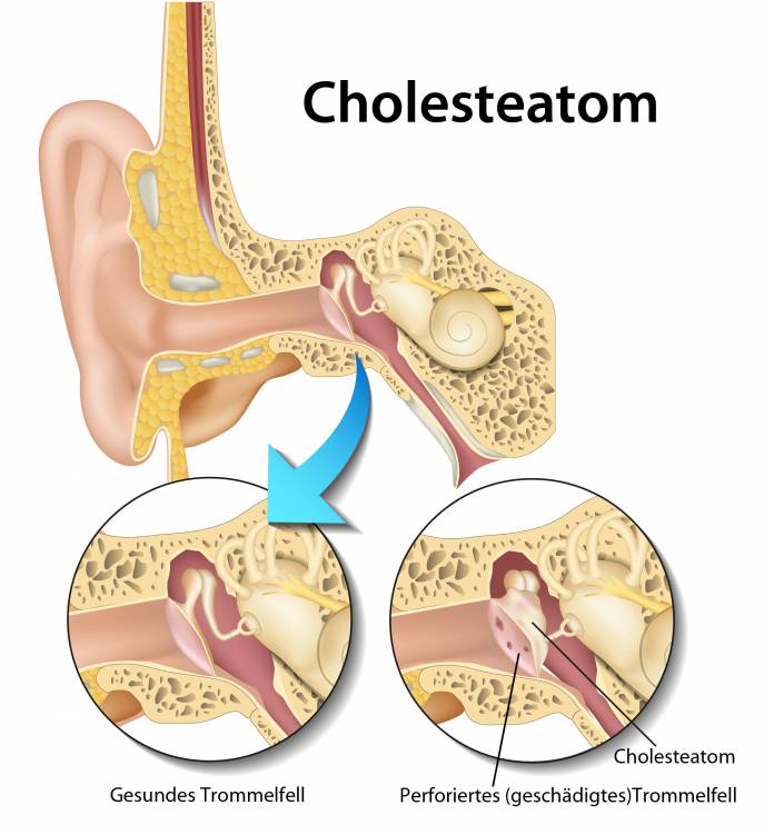 Cholesteatom