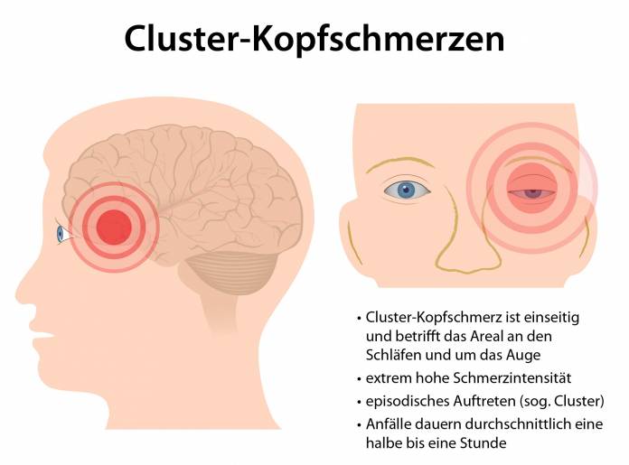 Cluster-Kopfschmerzen
