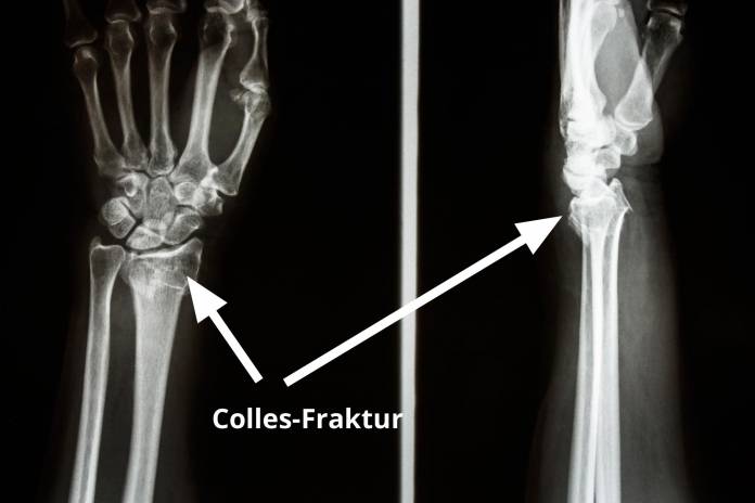 Colles-Fraktur