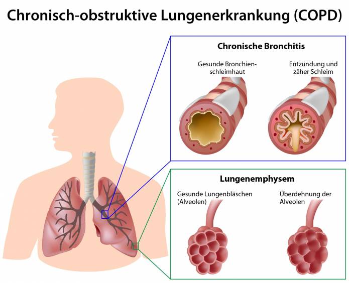 Chronisch-obstruktive Lungenerkrankung (COPD)