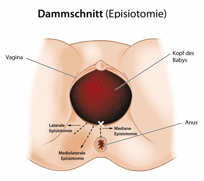 Dammschnitt (Episiotomie)