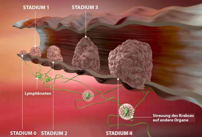Stadien der Darmkrebserkrankungen