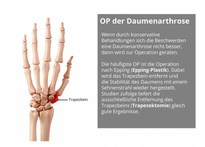 Operation der Daumenarthrose