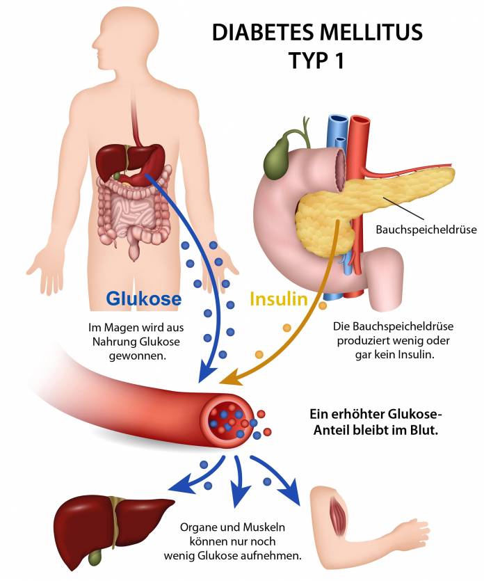 Diabetes Typ 1