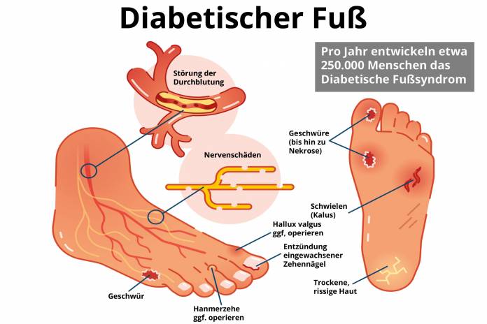 Diabetischer Fuß