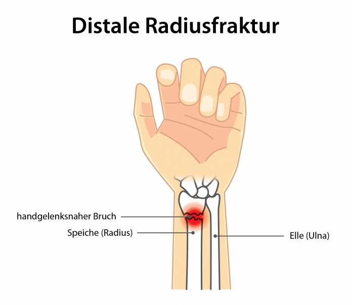 Distale Radiusfraktur