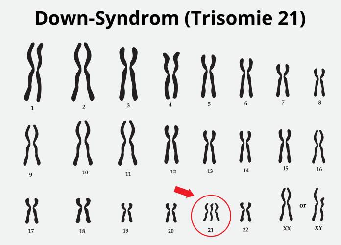 Down-Syndrom Chromosom 21