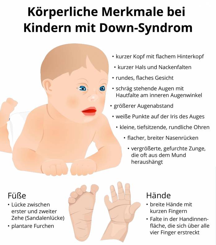 Körperliche Merkmale bei Kindern mit Down-Syndrom