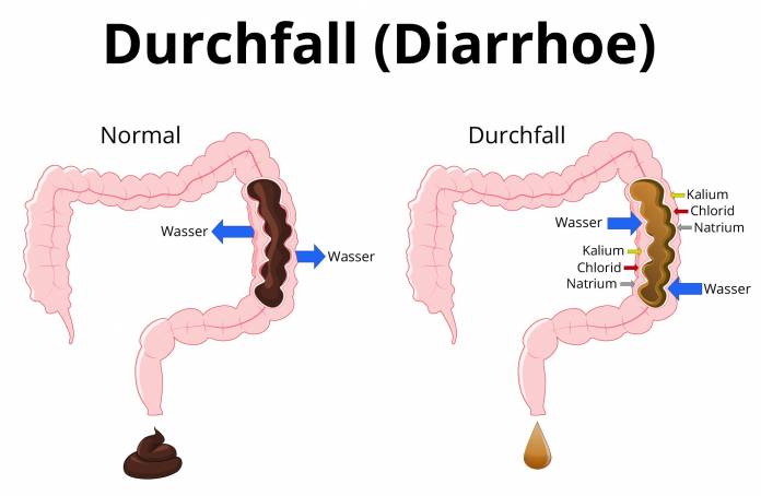 Durchfall (Diarrhoe)