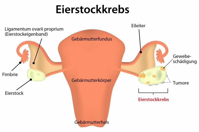 Eierstockkrebs