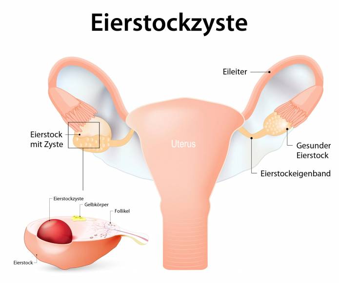 Eierstockzyste