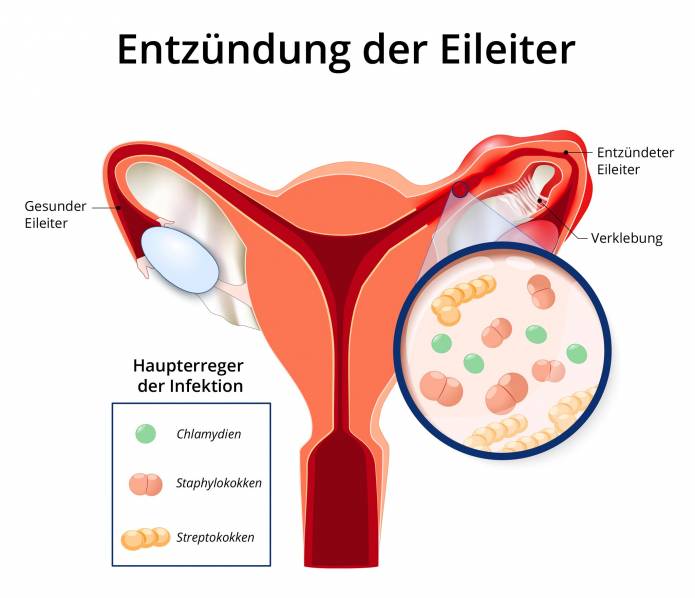 Entzündung der Eileiter durch Chlamydien