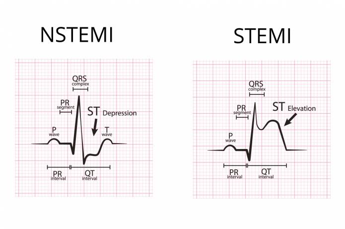 NSTEMI-Infarkt EKG