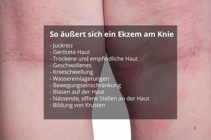 Ekzem am Knie