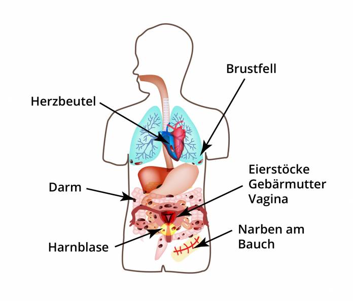 Bereiche, wo Endometriose auftreten kann