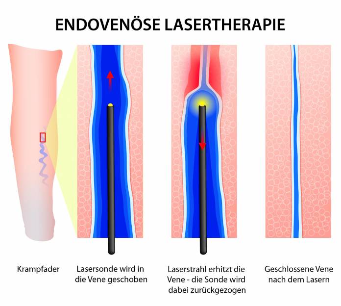 Endovenöse Lasertherapie bei Krampfadern