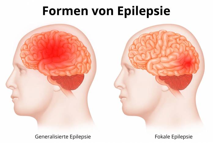 Formen von Epilepsie