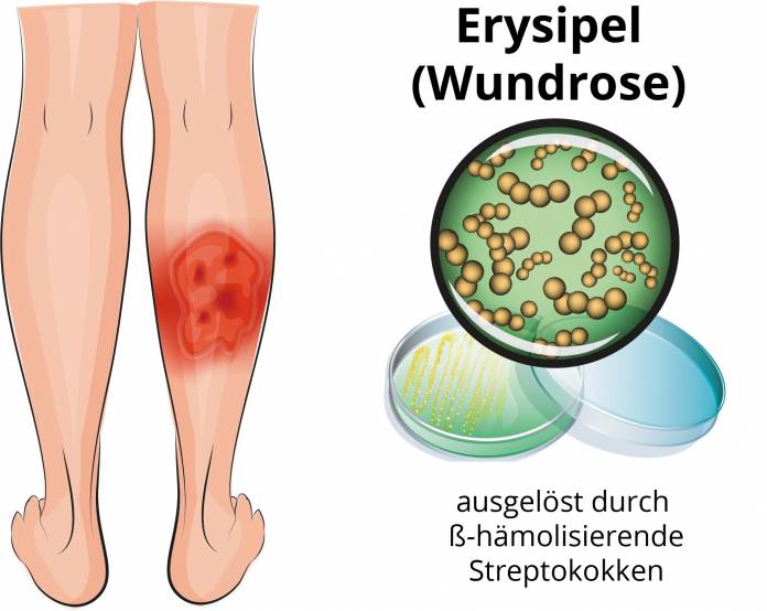 Erysipel (Wundrose)