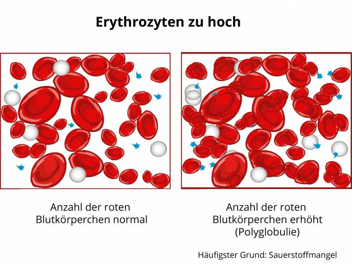 Erythrozyten zu hoch