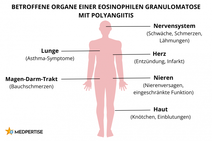 Betroffene Organe einer esinophilen Granulomatose mit Polyangiitis