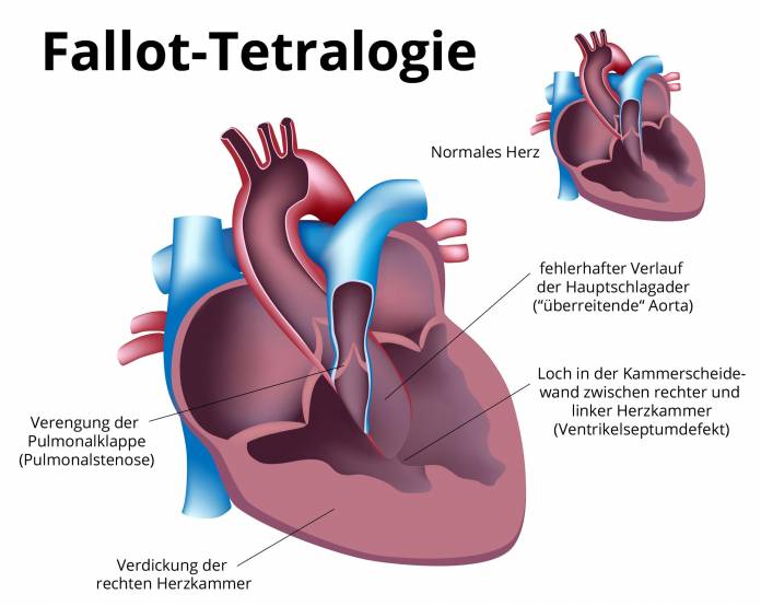Fallot-Tetralogie