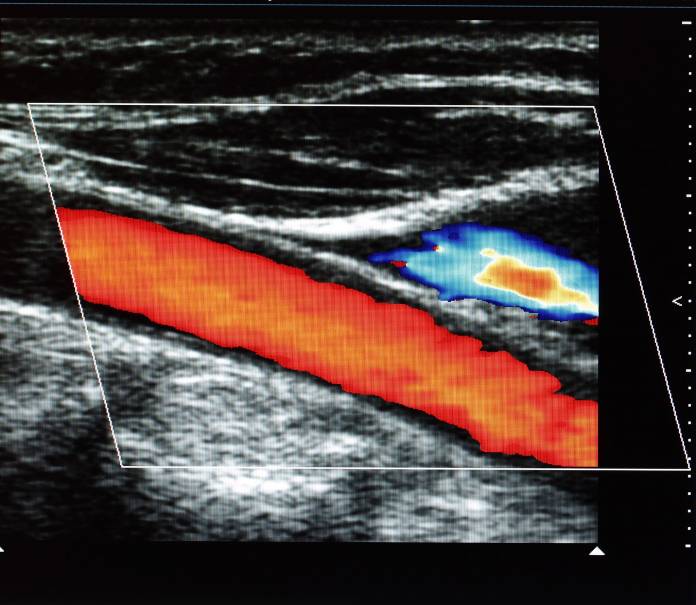 Farbkodierte Duplex-Sonographie