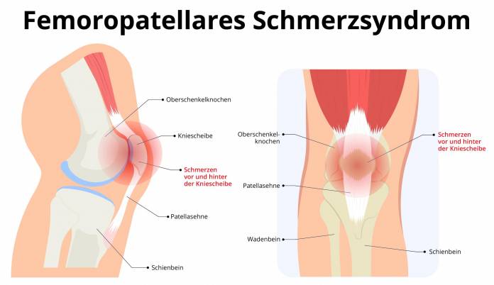 Femoropatellares Schmerzsyndrom