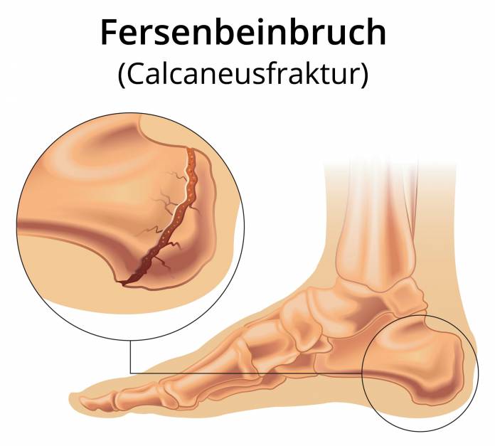 Fersenbeinbruch (Calcaneusfraktur)