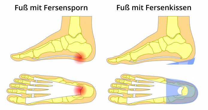 Fersenkissen bei Fersensporn