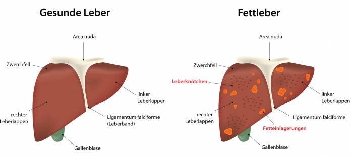 Fettleber