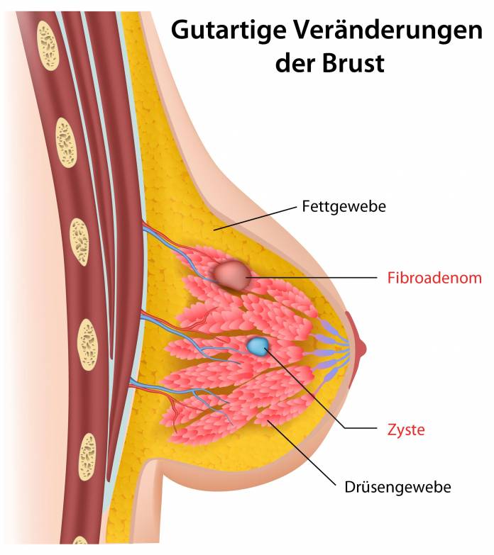 Gutartige Veränderungen der Brust