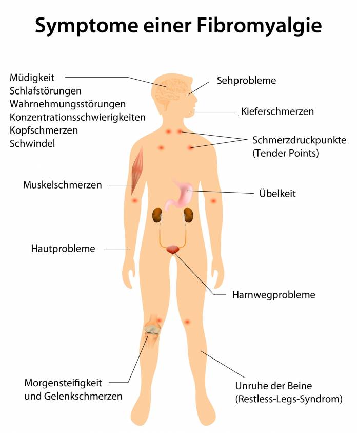 Symptome einer Fibromyalgie