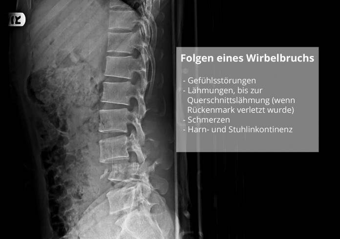 Folgen eines Wirbelbruchs