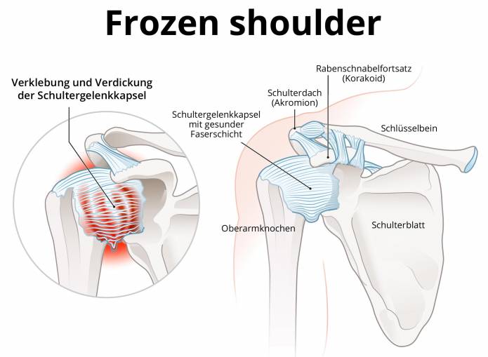 Frozen shoulder
