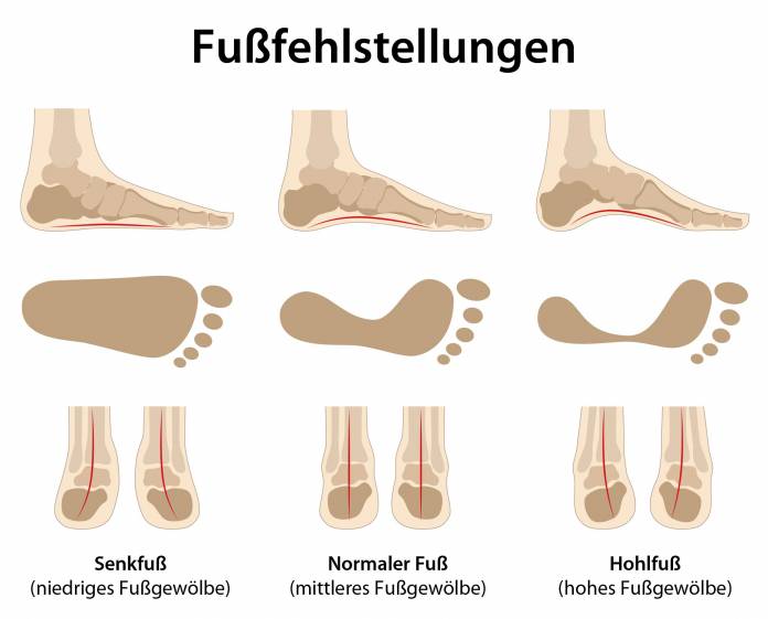 Fußfehlstellungen (Hohlfuß, Senkfuß)