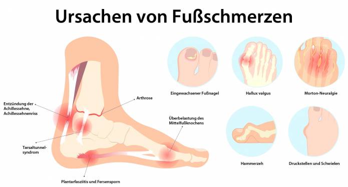 Ursachen von Fußschmerzen