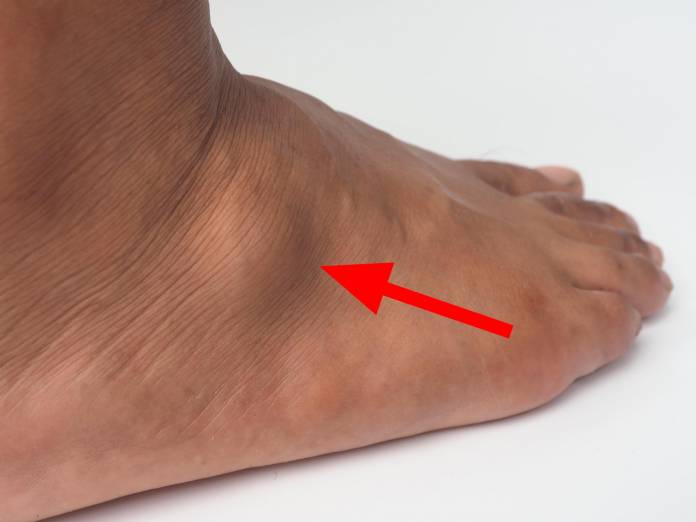 Ganglion am Fuß
