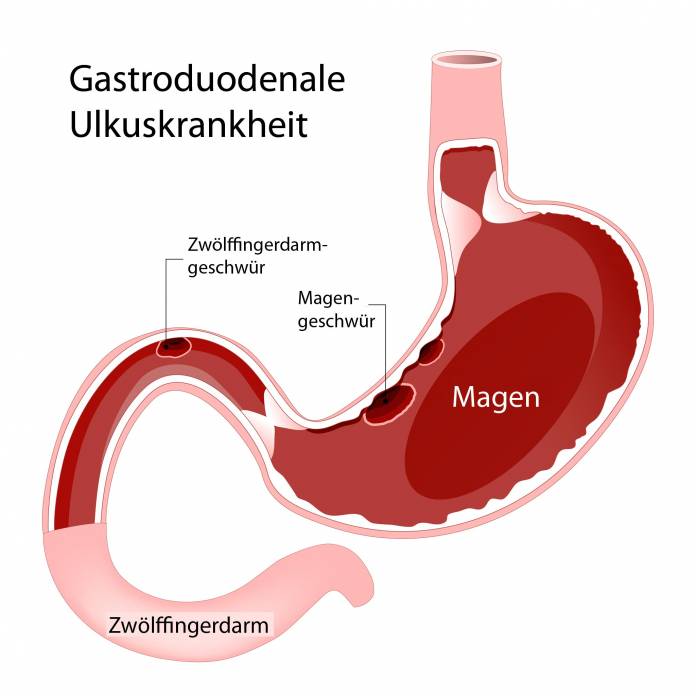 Gastroduodenale Ulkuskrankheit