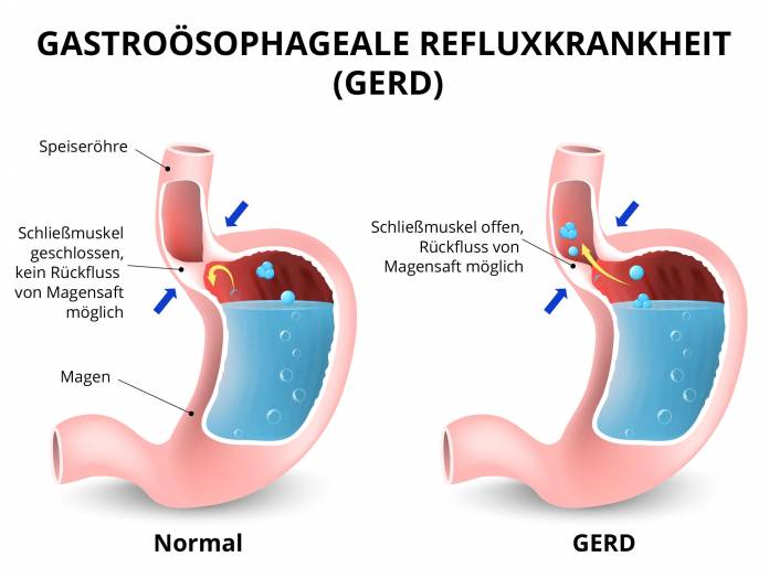 Gastroösophageale Refluxkrankheit