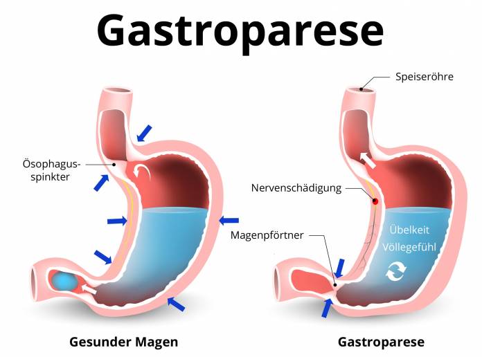 Gastroparese (Magenlähmung)