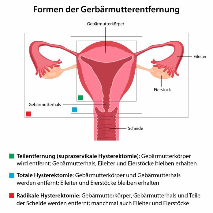 Formen der Gebärmutterentfernung