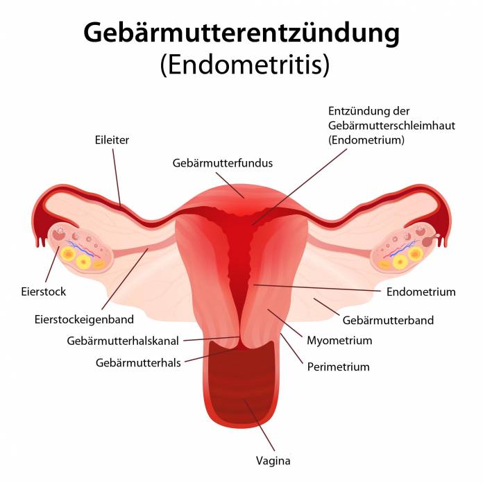 Gebärmutterentzündung (Endometritis)