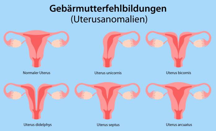 Gebärmutterfehlbildungen (Uterusanomalien)
