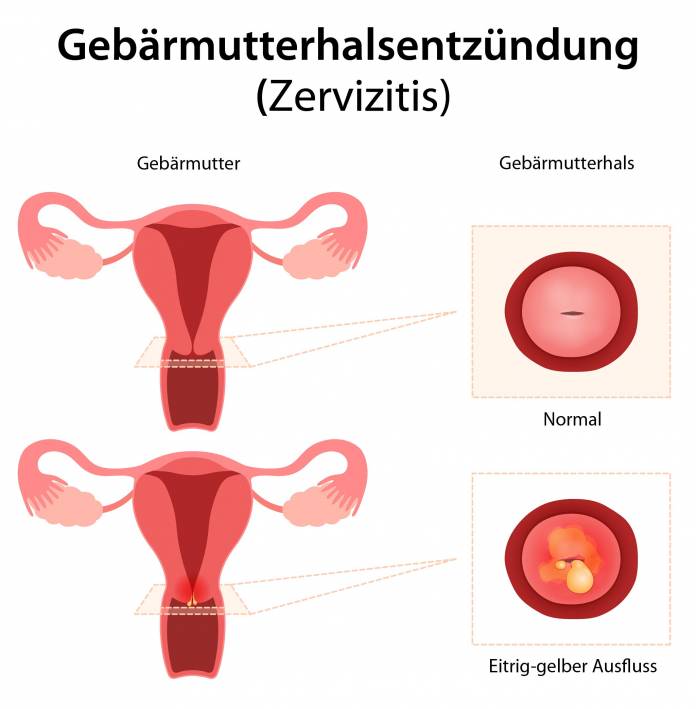 Gebärmutterhalsentzündung (Zervizitis)