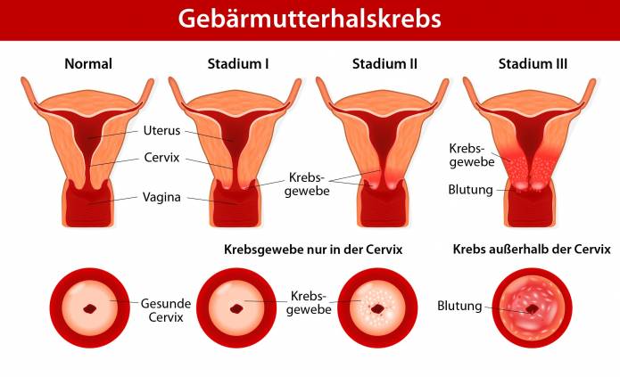 Stadien des Gebärmutterhalskrebses