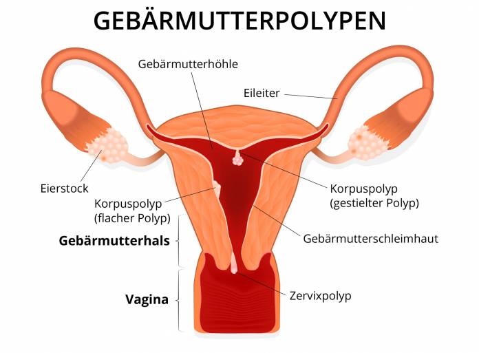 Gebärmutterpolypen