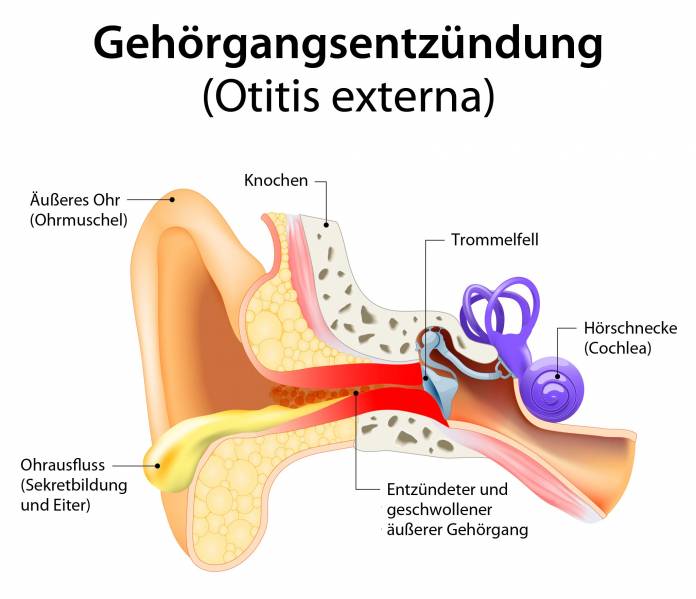 Gehörgangsentzündung (Otitis externa)