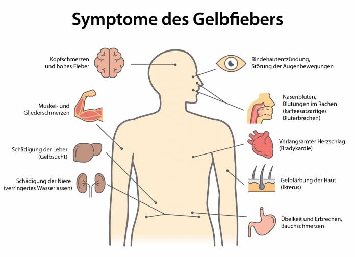 Symptome des Gelbfiebers