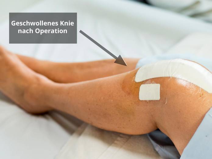 Wasser im Knie nach Operation des Meniskus » Behandlung