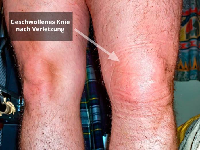 Geschwollenes Knie nach Verletzung